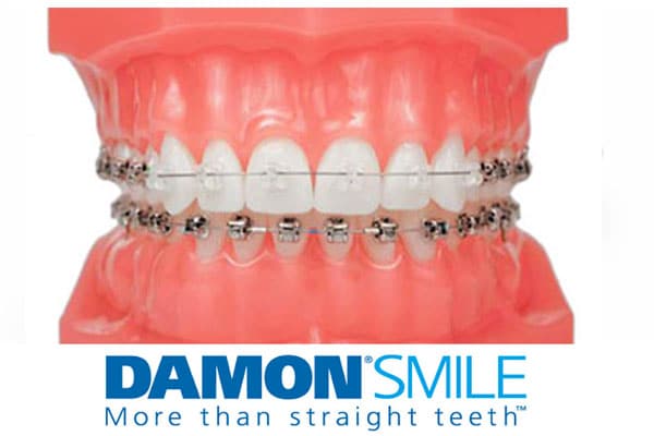 Damon self-ligating braces