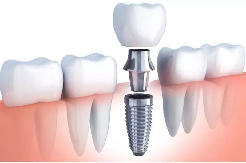Dental implant