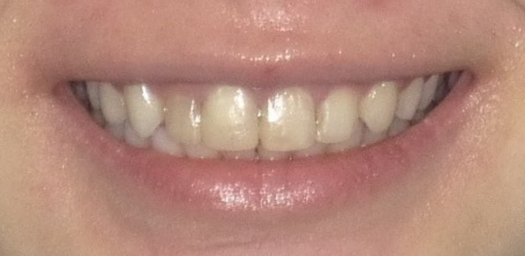 Before treatment: dark, uneven, root canal-stained teeth