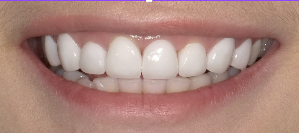 After treatment: bright, aligned smile with veneers and crowns