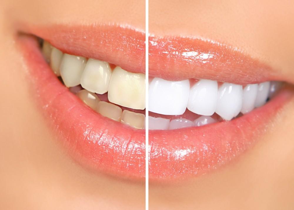 Before and after Philips Zoom teeth whitening