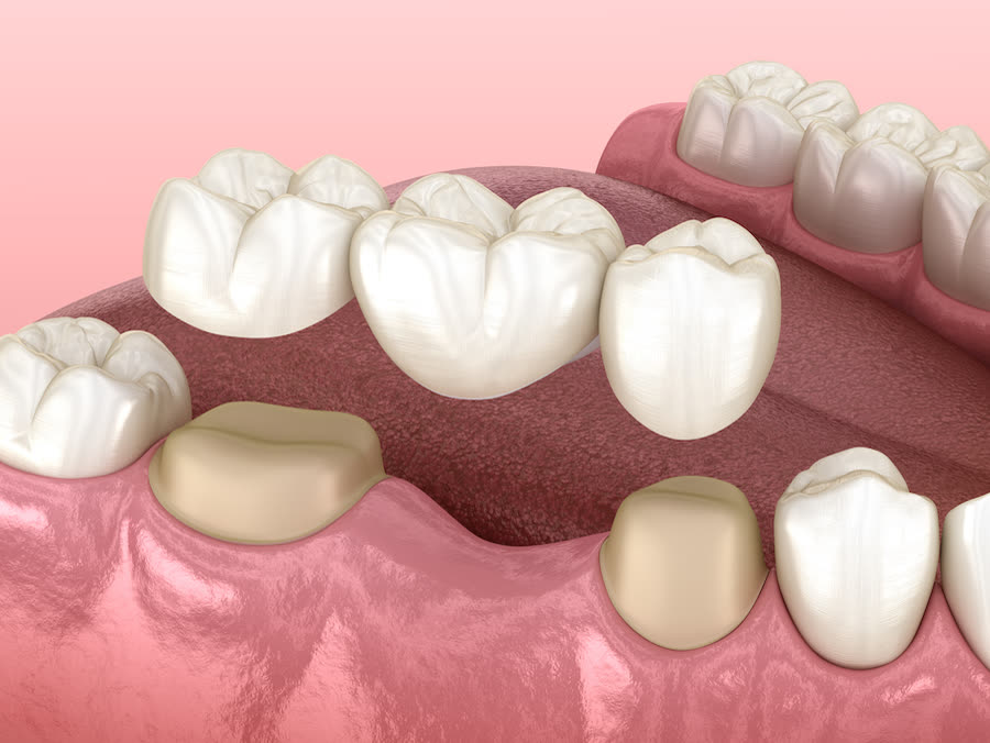 Dental crowns and bridges