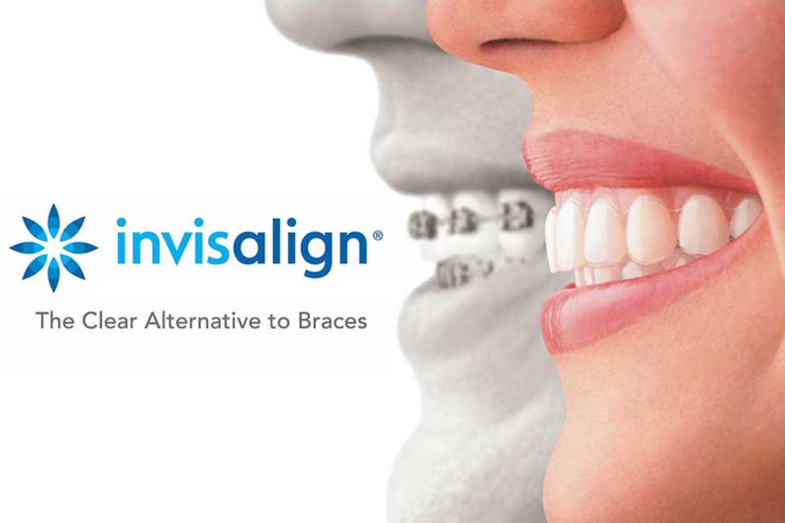 Invisalign clear aligners