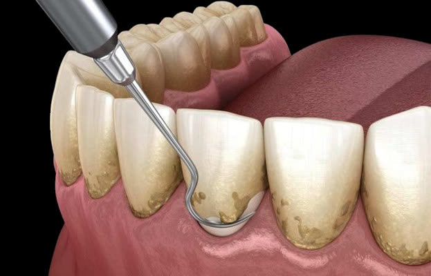 Professional gum treatment and cleaning