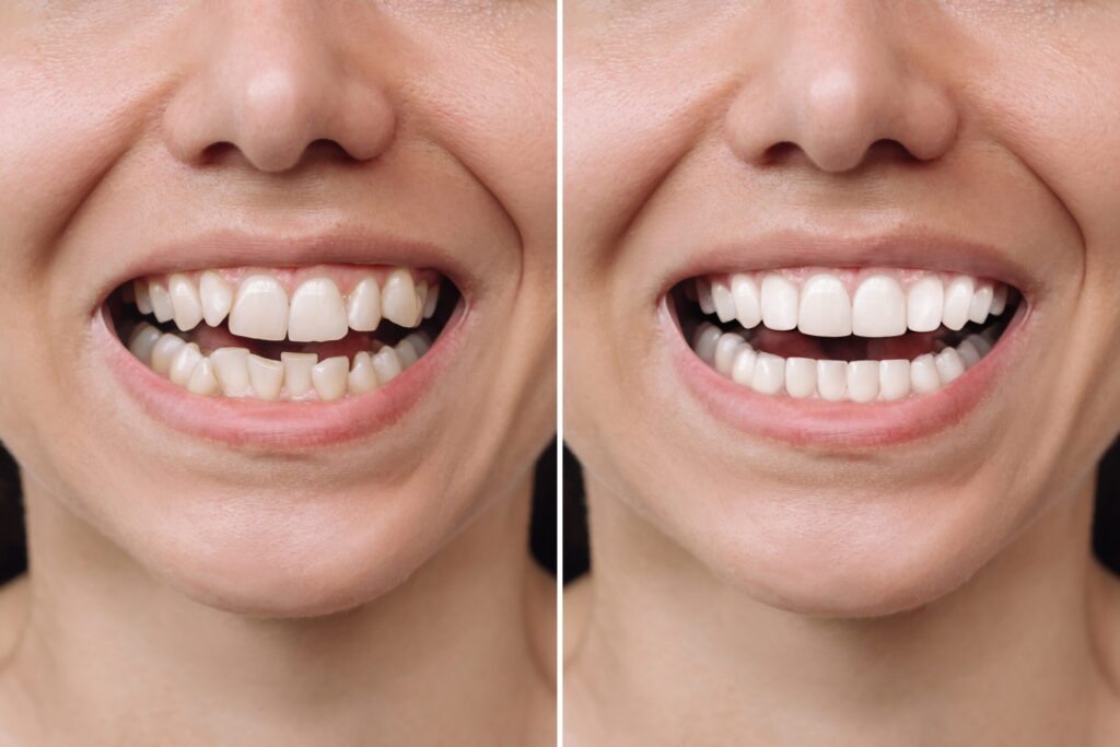 Porcelain veneers before and after