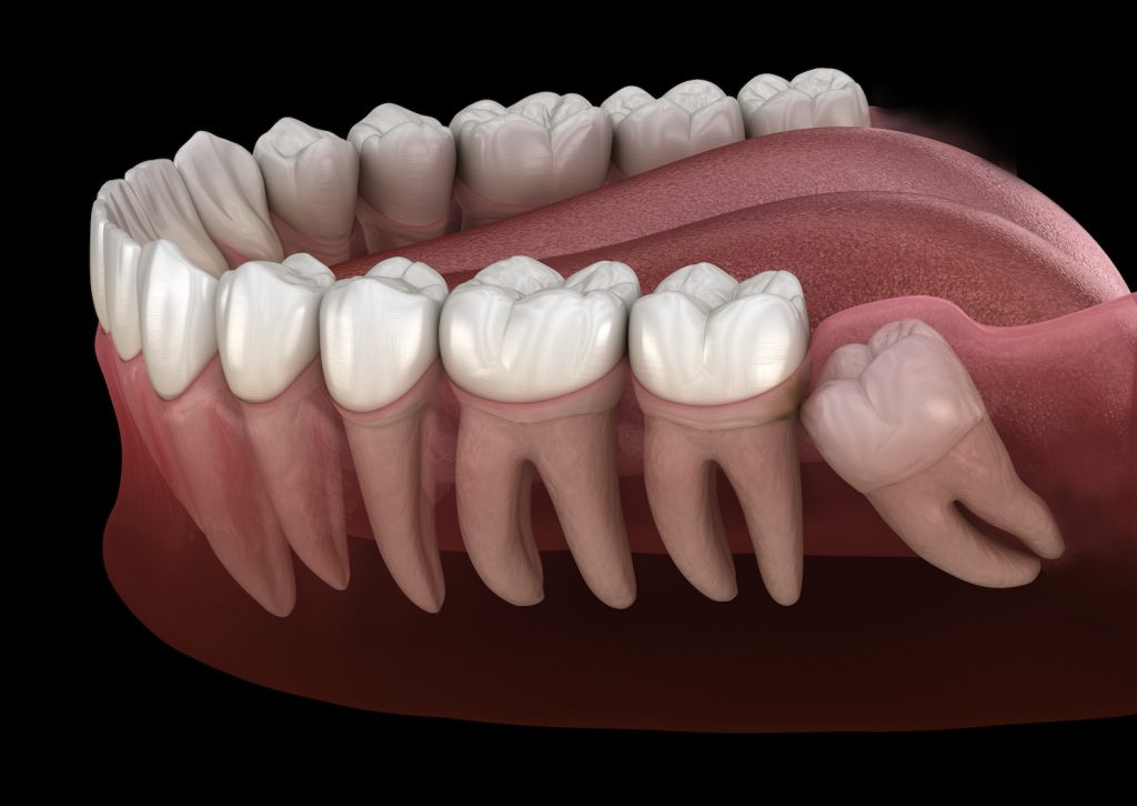 Minor oral surgery — wisdom tooth removal